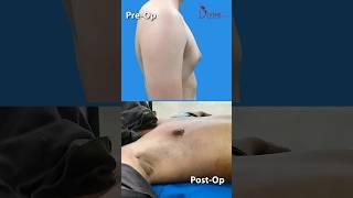 Gynecomastia Result ! Grade 2A - Removed Fat and Gland | Gynecomastia Surgery #shorts