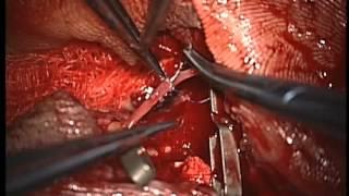 Микрохирургическая техника:шов пальцевой артерии /Microsurgical technique:digital artery anastomosis