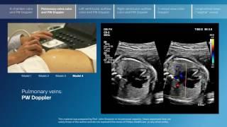 Advanced screening views of the fetal heart - Part 2 - Pulmonary veins color and PW Doppler