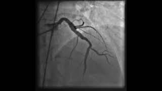 Figure 4: A depiction of the significant progress - complete resolution of the clot