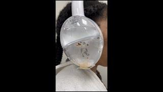 FDA-Cleared OtoSet® Ear Cleaning System - Earwax Removal Procedures