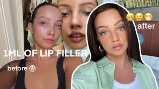 getting lip fillers for the first time - healing process start to finish