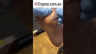 Pinch callus removal by cutting with a scalpel in the podiatry clinic . Satisfying for you?
