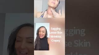 Goodbye, sagging neck ‍️#microneedling #skin #skincare #skincareroutine #beauty