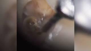 Endodontic microsurgery on phantom. Tooth #16.