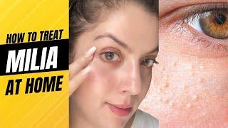 Milia treatment I How to treat Milia at Home | How to treat Milia under eyes | Milia removal cream