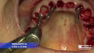 IMPLANTES INMEDIATOS · REHABILITACIÓN MAXILAR · DR ISMAEL SORIANO - FORMACIÓN EN IMPLANTOLOGÍA