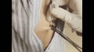 NAZ MiLA  GÖBEK DELiĞiNE PiERCiNG (DÖVME YAPTIRDI)