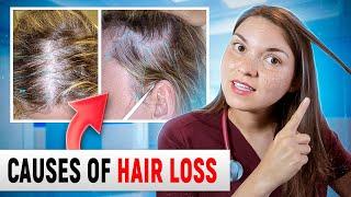 What HAIR LOSS Says About Your HEALTH: Top 15 Causes of Hair Loss (Doctor Explains)