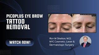 Eyebrow Tattoo Correction with PicoPlus Laser NYC | Dr. Ron Shelton