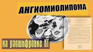 ОЧАГОВЫЕ образования печени на РАСШИФРОВКЕ КТ брюшной полости.  АНГИОМИОЛИПОМА печени.