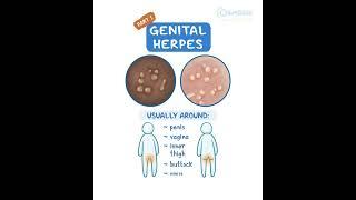 Genital Herpes