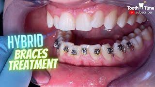 Hybrid orthodontic treatment - Braces & Clear Aligners together - Tooth Time Family Dentistry NBTX