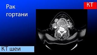 Лучевая диагностика рака гортани