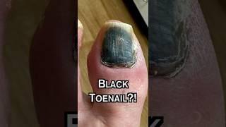 Why is my TOENAIL BLACK?! 