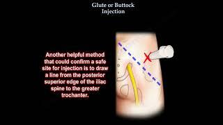 Glute injection, buttock injection