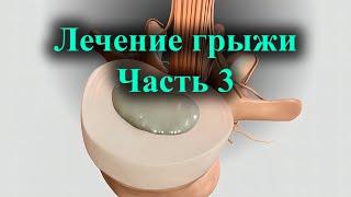 Правильное лечение межпозвоночной грыжи. НПВС, массаж,  процесс развития хронической боли. Ч 3