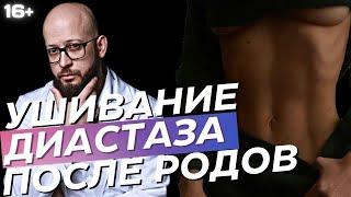 Как ушивают диастаз после родов? Операция по ушиванию диастаза после беременности. Абдоминопластика