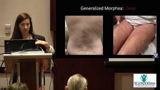 Localized Scleroderma (Morphea)- Lisa Pappas-Taffer, M.D.-  2018 Patient Education Conference