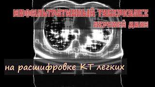 ИНФИЛЬТРАТИВНЫЙ ТУБЕРКУЛЕЗ верхней доли левого легкого на расшифровке КТ органов грудной полости