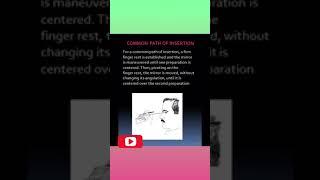 Prosthohub #taper, path of insertion #YouTube Shorts