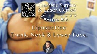 Liposuction - Dr. Mark Jabor, Cosmetic Surgery & Laser Center of El Paso