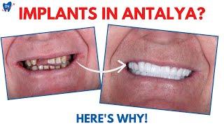 Dental Implants in Antalya: What Top Dentists in Turkey Want You to Know!