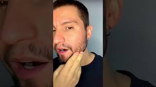 Beard Transplant Before and After  | Elithair #shorts