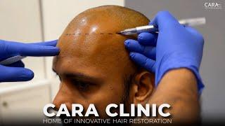 CARA Hair Transplant : Home of Innovative Hair Restoration