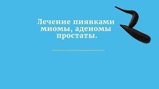 Лечение пиявками миомы, аденомы простаты.