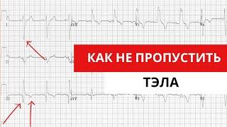 Как не пропустить тромбоэмболию легочной артерии (ТЭЛА). ЭКГ признаки ТЭЛА.