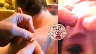 Big Pimples Popping! Pimple Popping Compilation/ Подборка Сочные ПРЫЩИ/ ВЫДАВЛИВАНИЕ Огромных ПРЫЩЕЙ