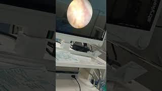 PCNL Surgery 15 mm stone Removal for Kidney #doctor #health #hospital