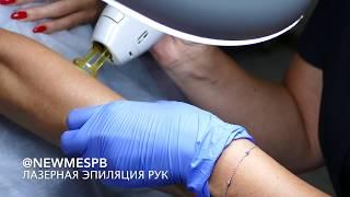 Лазерная эпиляция рук с помощью александритового лазера Candela Gentlelase Pro