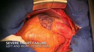 Double HVAD implantation for Biventricular dysfunction