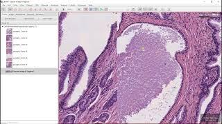 Pixel classification with QuPath (epithelium and stroma segmentation with H&E images)