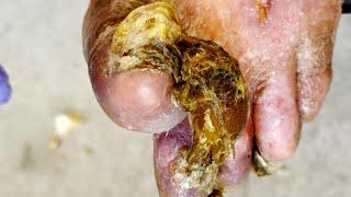 Oh My God, Dirty Skin Covered With Onychomycosis, Complete Pedicure【Xue Yidao】