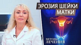 Эрозия шейки матки. Методы лечения