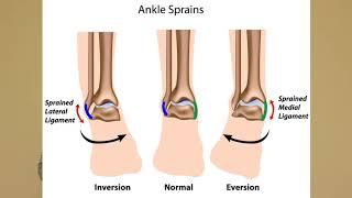 Ankle Sprains 101 - Physical Therapy, Sterling, VA