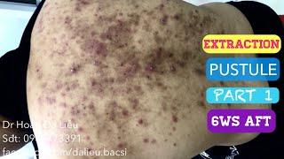 Mụn trứng cá mủ đầy lưng|Dermatologist,pimples, blackhead,pustule full back extraction 6ws after