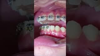 Orthodontic Bite Plate and Braces - When I get my bottom braces? Tooth Time Family Dentistry Texas