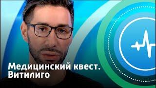 Медицинский квест. Витилиго | Телеканал «Доктор»