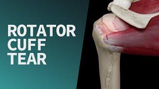 Rotator Cuff Tear