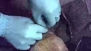 Инъекция в кость