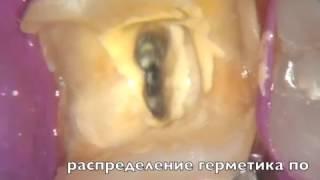 Лечение канала зуба с нестандартной анатомией.
