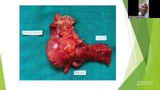 PG CLINICS GASTRIC OUTLET OBSTRUCTION RIF MASS