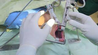 Little angel goes under general anesthesia for Adenotonsillectomy #anesthesia