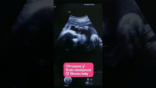 Ultrasound of brain development of 5month baby #pregnancy #baby #ultrasound