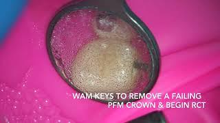 WAM Key crown removal