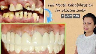 full mouth rehabilitation for attrited teeth | #shorts